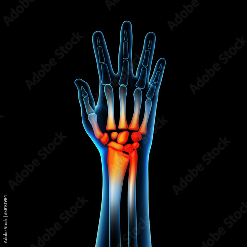 Illustration: 3d rendered anatomy illustration - hand pain 3d rendered anatomy illustration - hand pain