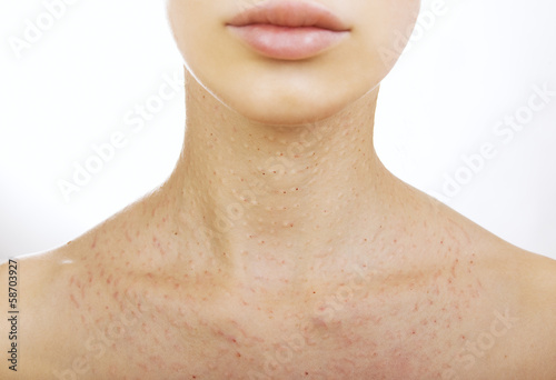Photo: Female neck after hyaluronic injection (collagen biorevitalizati Female neck after hyaluronic injection (collagen biorevitalizati
