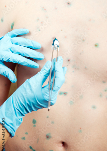 Photo: Chickenpox. Skin rash. Viral disease. Chickenpox. Skin rash. Viral disease.