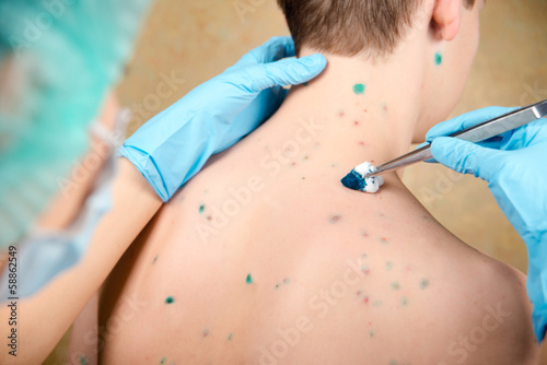 Photo: Chickenpox. Skin rash. Viral disease. Chickenpox. Skin rash. Viral disease.
