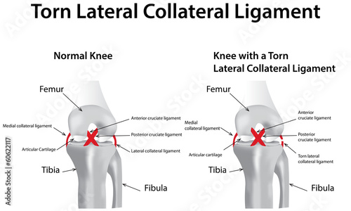 Vector: Torn Lateral Collateral Ligament Torn Lateral Collateral Ligament