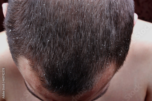 Photo: Psoriasis skin Psoriasis skin