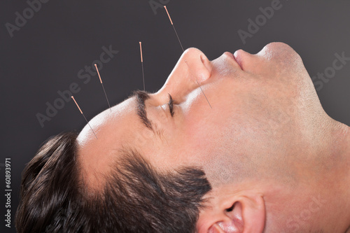 Photo: Man Undergoing Acupuncture Treatment Man Undergoing Acupuncture Treatment