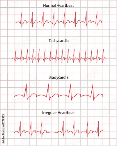 Illustration: ECG Pathology DIsease ECG Pathology DIsease