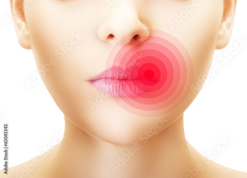 Photo: Lips affected by herpes, shown red. Lips affected by herpes, shown red.