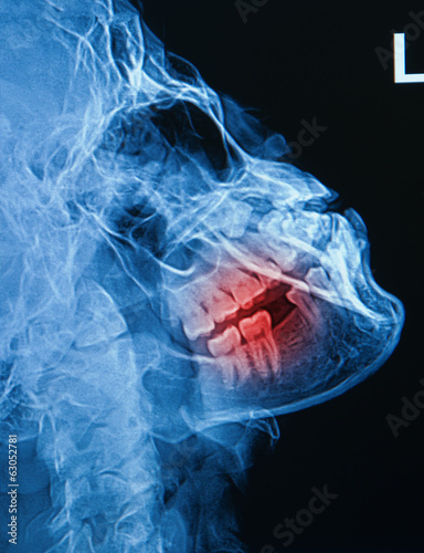 Photo: x-ray image of human skull show fracture mandible x-ray image of human skull show fracture mandible