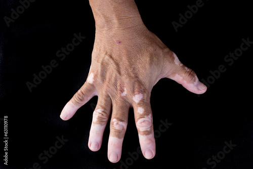 Photo: Quadrichrome vitiligo Quadrichrome vitiligo