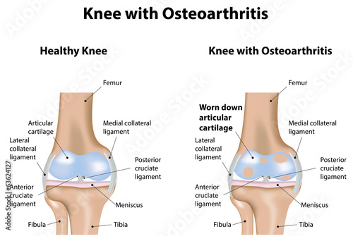 Vector: Knee Joint with Osteoarthritis Diagram Knee Joint with Osteoarthritis Diagram