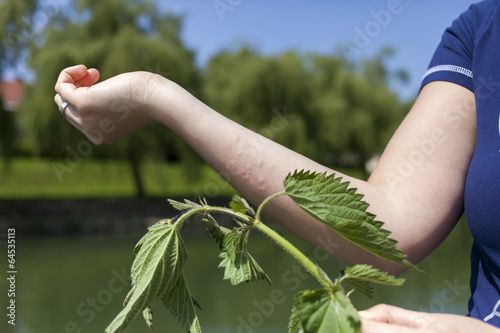 Photo: Acute allergic reaction after touching stinging nettle leaves Acute allergic reaction after touching stinging nettle leaves