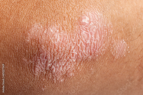 Photo: Psoriasis on elbow skin Psoriasis on elbow skin
