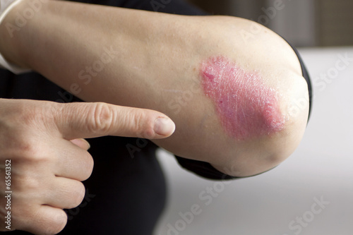 Photo: Psoriasis on elbow Psoriasis on elbow