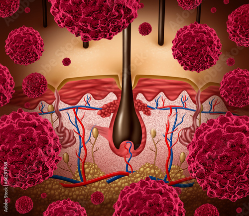 Illustration: Skin Cancer Skin Cancer