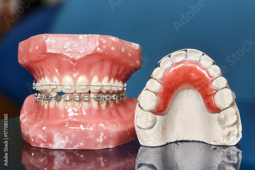 Human jaw or teeth model with metal wired dental braces