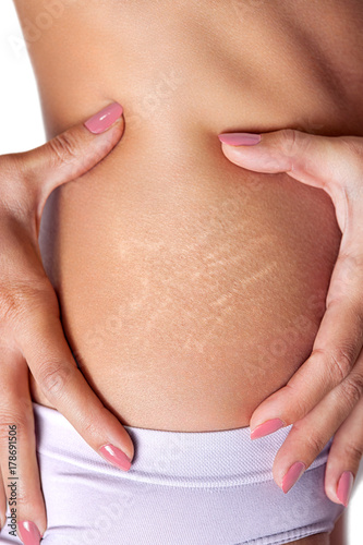 Stretch marks on female skin
