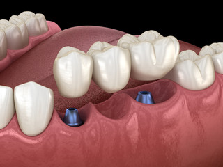 Dental bridge supported by implants. Medically accurate 3D illustration of human teeth and dentures concept