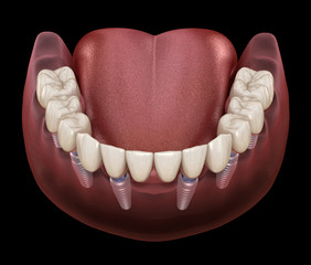 Mandibular prosthesis All on 6 system supported by implants. Medically accurate 3D illustration of human teeth and dentures concept