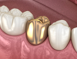 Golden crown premolar tooth assembly process. Medically accurate 3D illustration of human teeth treatment