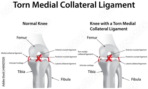 Torn Medial Collateral Ligament Poster #F60621328 - PrintMePoster.com