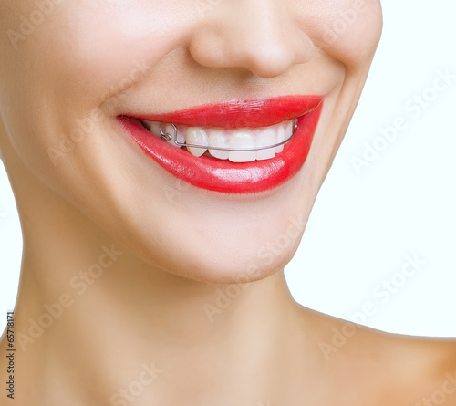 Fototapeta Beautiful smiling girl with retainer for teeth