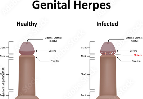 Herpes On Base Of Shaft - myherpestips.com