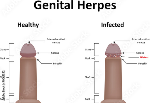 Bumps on Penis - Herpes Ulcer, Spots, Warts on Genitals ...