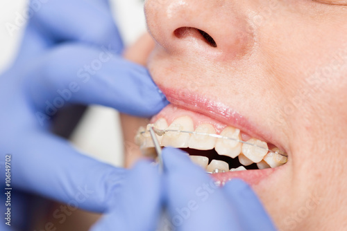 Zdjęcia Invisible ceramic braces