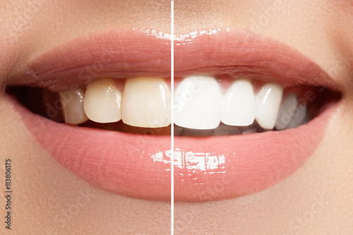 Zdjęcia Perfect smile before and after bleaching