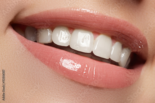 Zdjęcia Perfect smile before and after bleaching