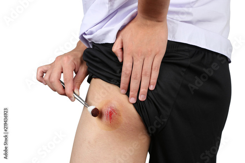 Bruised Wound Injury On Skin Butt Or Skin Bum Of Asian Young Boy Close Up Bruised Wound Injury On Skin Butt Or Skin Bum Of Asian Young Boy Close Up