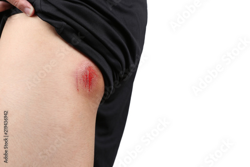 Bruised Wound Injury On Skin Butt Or Skin Bum Of Asian Young Boy Close Up Bruised Wound Injury On Skin Butt Or Skin Bum Of Asian Young Boy Close Up