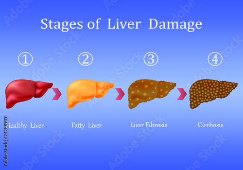 Stages of liver damage, liver disease. Healthy, fatty, liver fibrosis ...