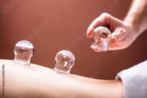 Therapist Placing Glass Cups On Woman's Back © Andrey Popov